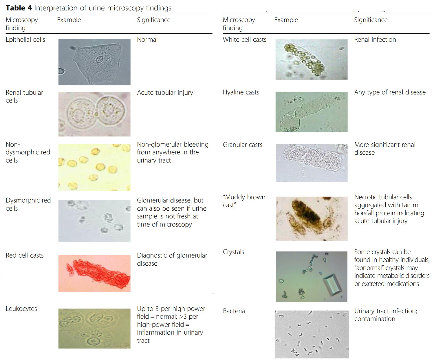 Cast Epiteliale Nelle Urine Cast Epiteliale Nelle Urine