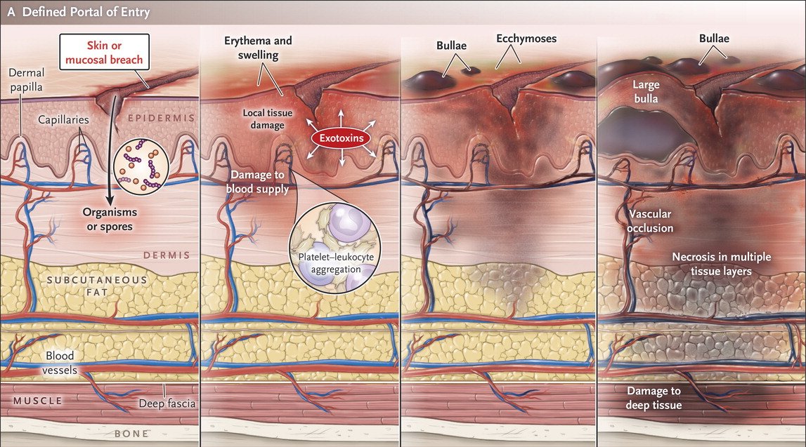 Evolution Of Necrotizing Fasciitis Or Myonecrosis Pathophys GrepMed Evolution Of Necrotizing Fasciitis Or Myonecrosis Pathophys GrepMed