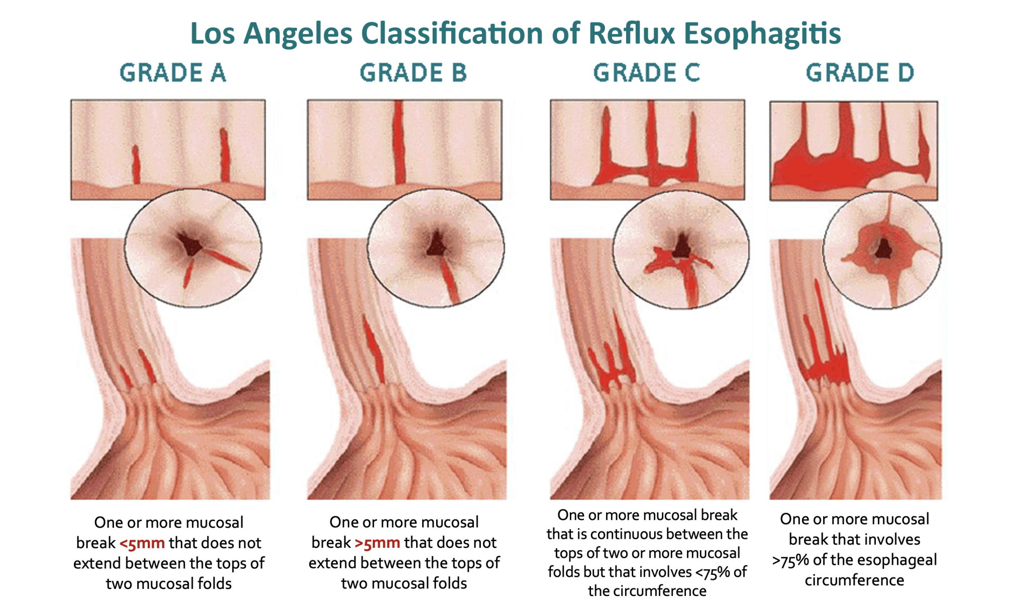 Alexander Hann On X Los Angeles Classification For Reflux 45 OFF