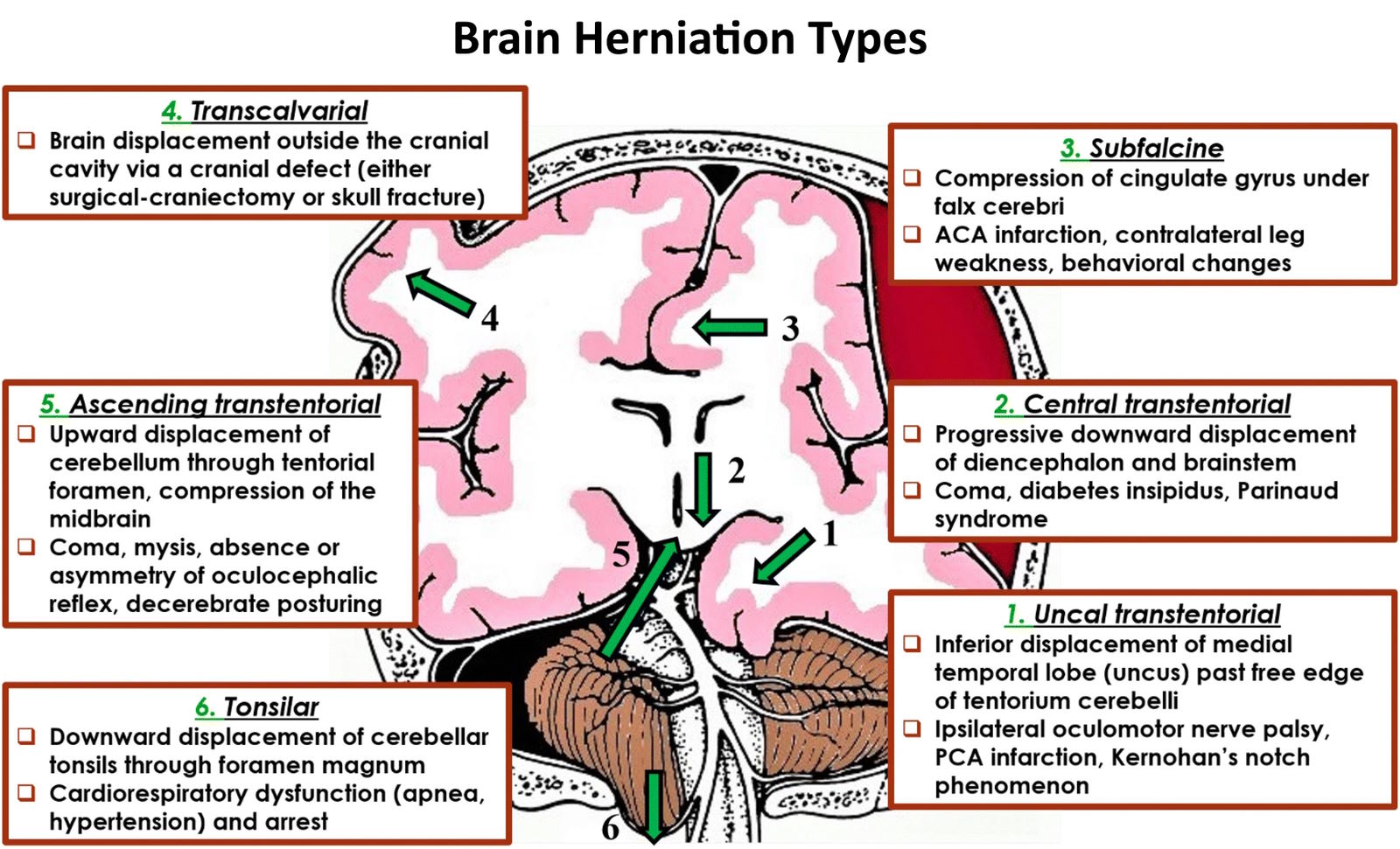 Tentorial Herniation