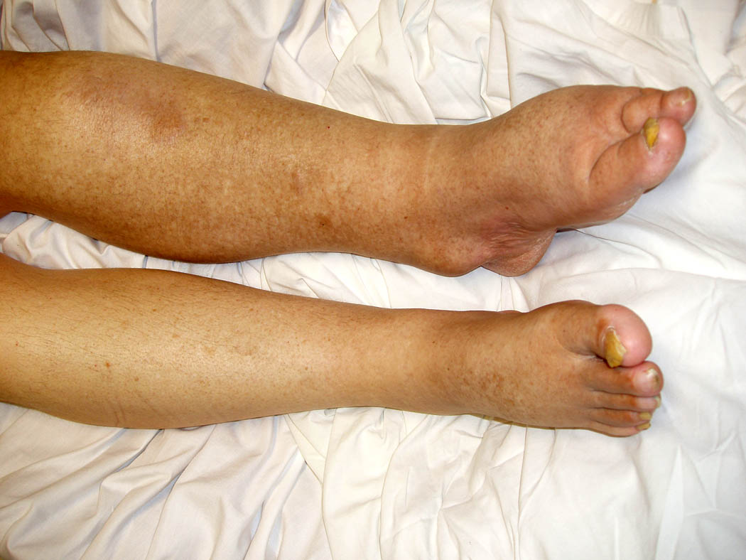 Lower Extremity Lymphedema and Edema