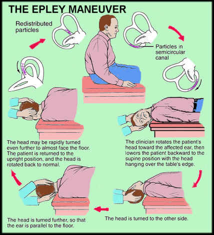 at home epley maneuvers for vertigo