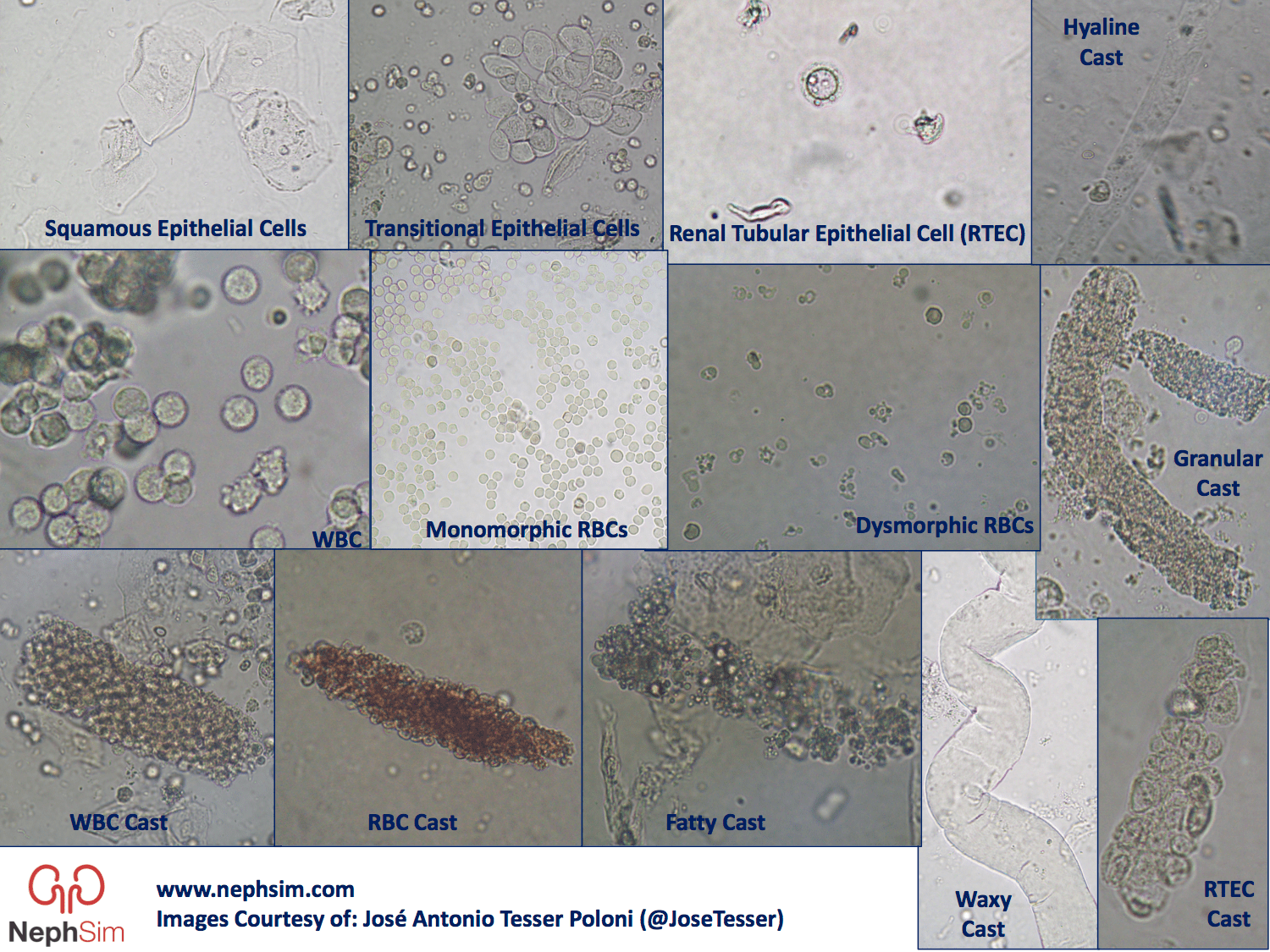 Cellular Cast In Urine