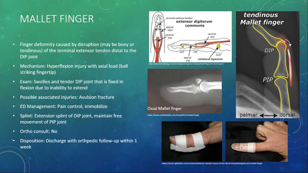 Mallet Finger Absence of a fracture does NOT exclude ... | GrepMed