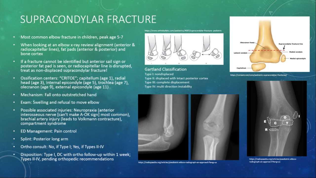 Supracondylar Elbow Fracture Most Common Elbow Fracture In Children Supracondylar Elbow Fracture Most Common Elbow Fracture In Children